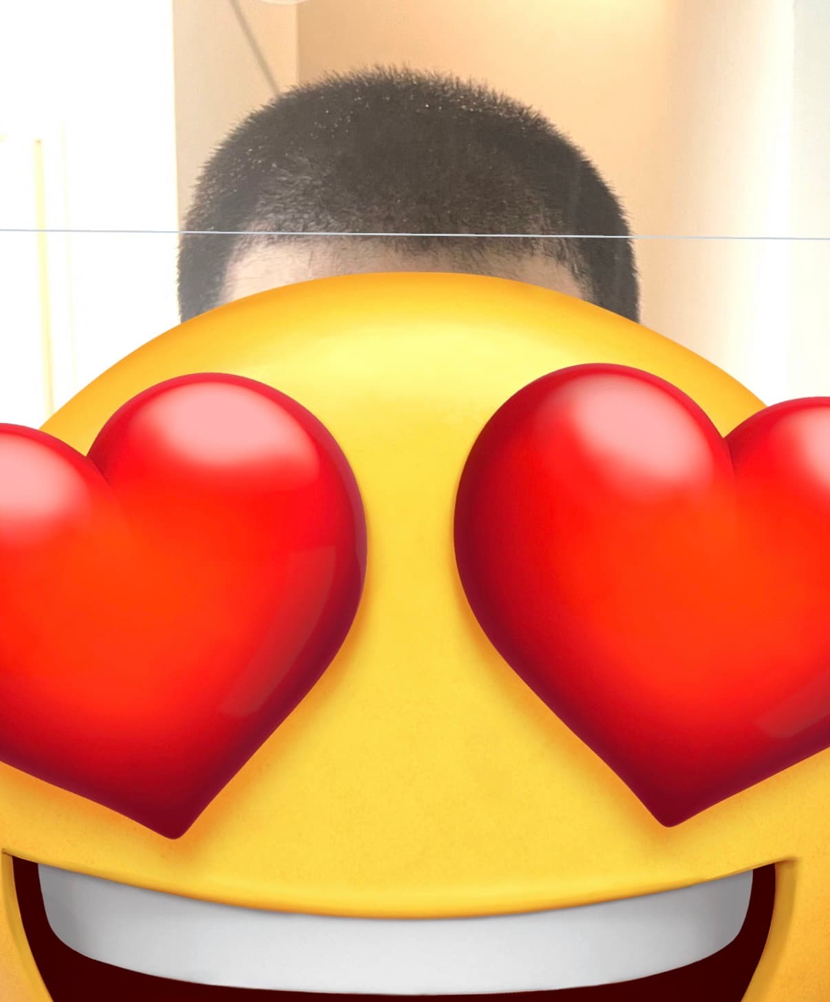 植毛1ヶ月後 - ショックロス時期