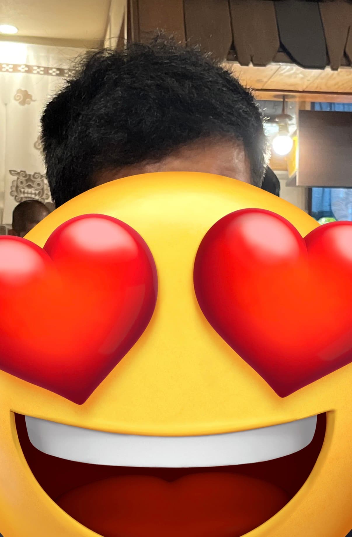 植毛6ヶ月後 - 回復